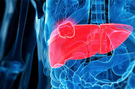 Cirrhosis Complications at Livasa Mohali - Prevention & Management